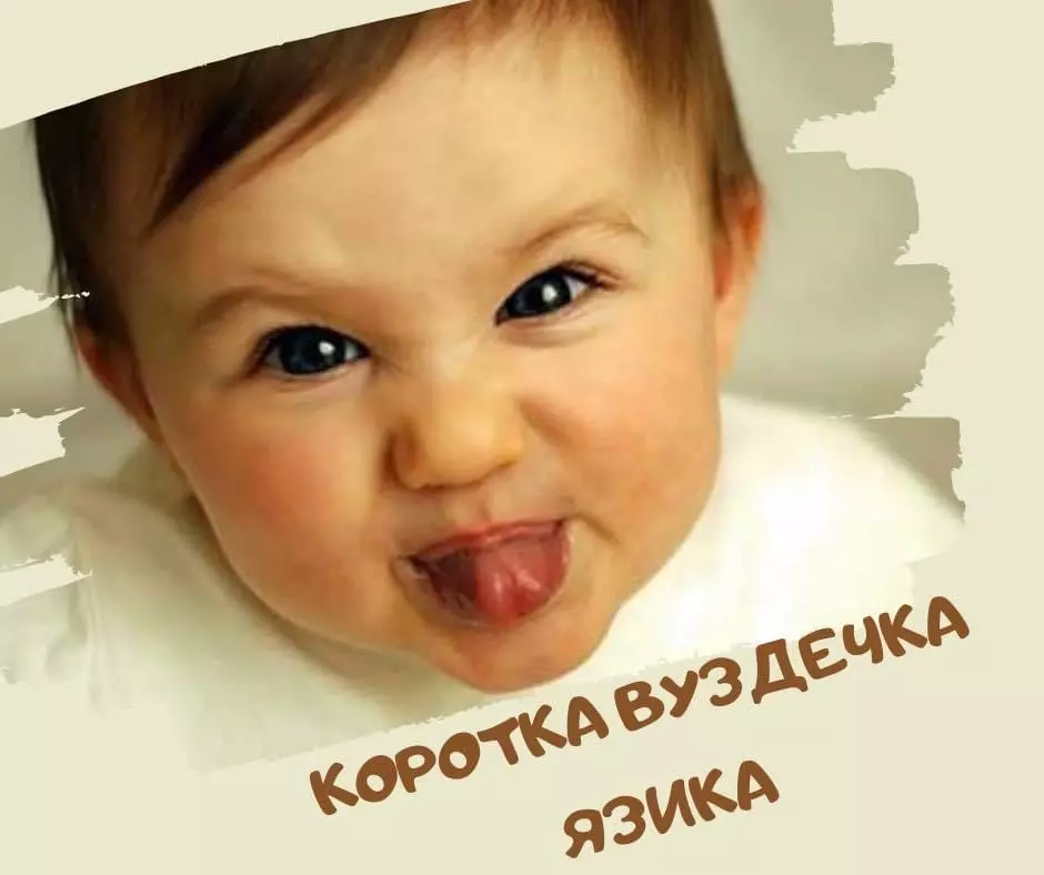 Коротка вуздечка язика