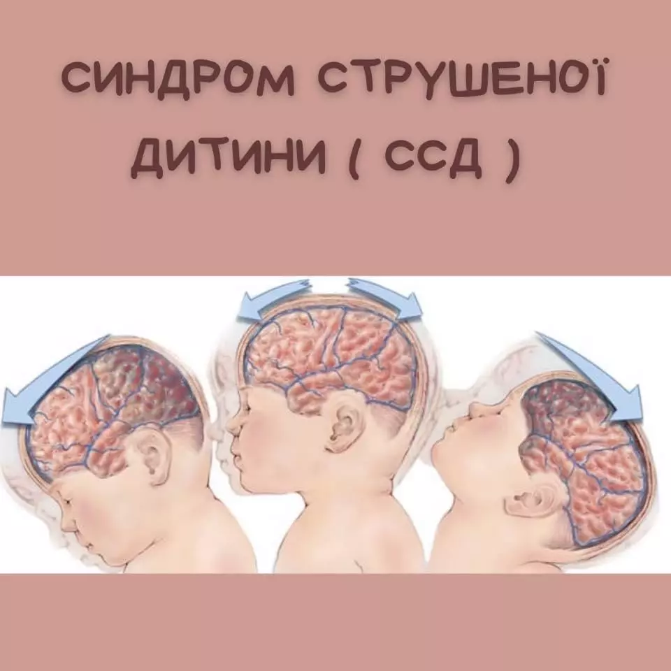 Синдром струшеної дитини